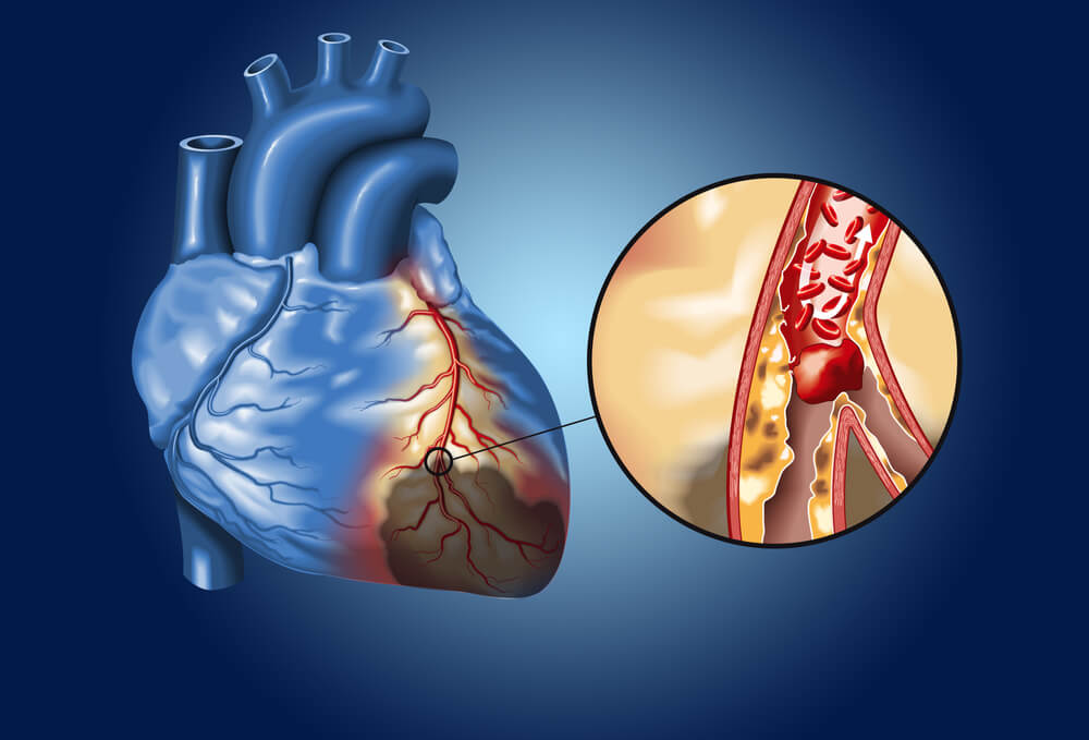 Atherosclerotic Coronary Artery Disease Management