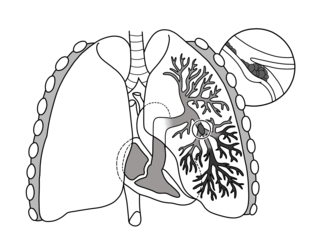 Pulmonary Embolus (PE)
