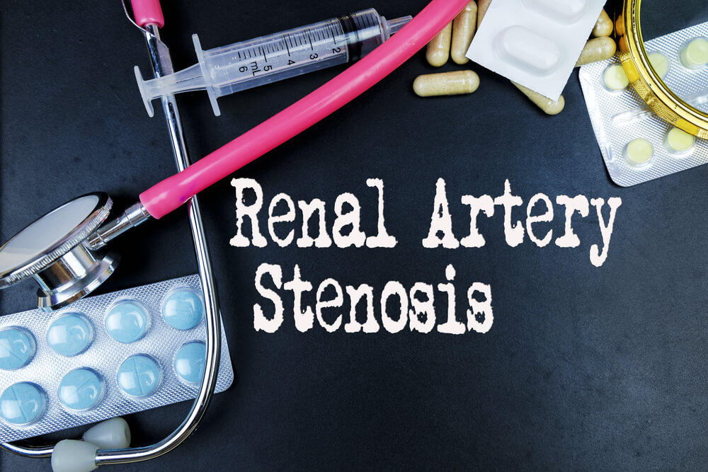 Diagnostic imaging illustrating the narrowing of vessels in renal artery stenosis, a condition affecting blood flow to the kidneys.