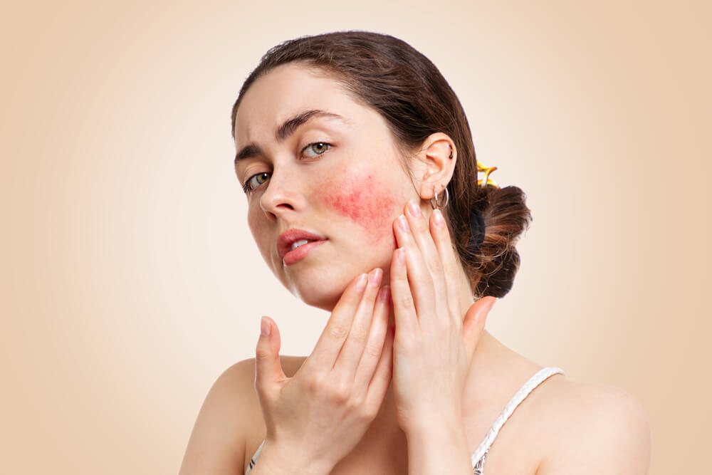 Rosacea: Unveiling the Redness of the Face
