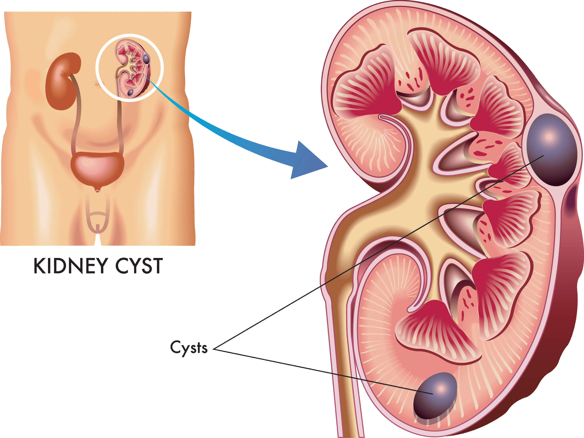 Expert Guidance on Simple Kidney Cysts by Dr. Juan S. Pico